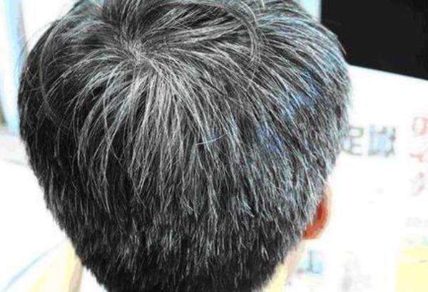 年轻人为什么会长白头发为你分析导致白发的三大原因